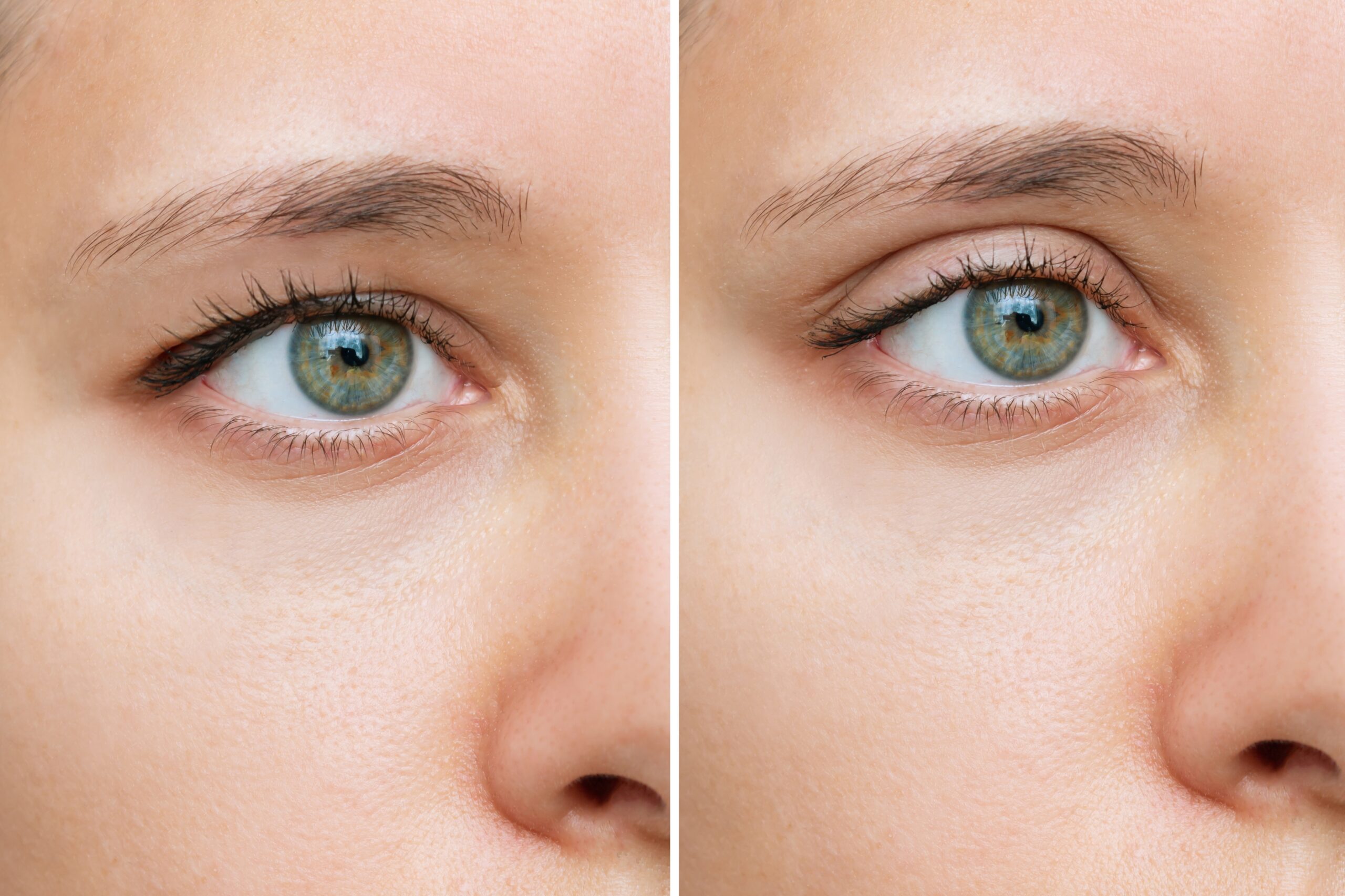 example of before and after of a blepharoplasty from shutterstock